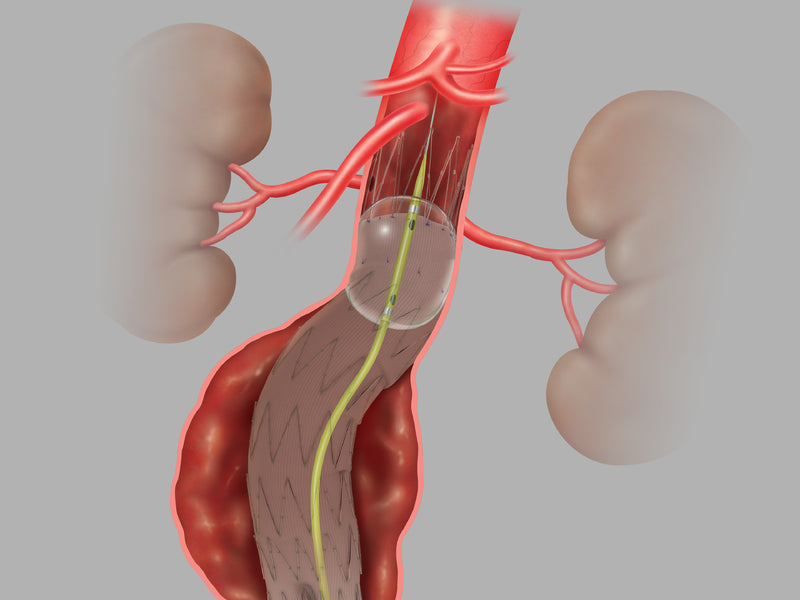 Coda® and Coda® LP Balloon Catheter